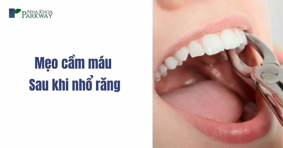 Mẹo cầm máu sau khi nhổ răng cực kì hiệu quả