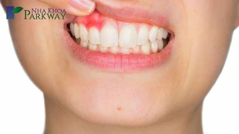 Viêm chân răng là bệnh như thế nào?