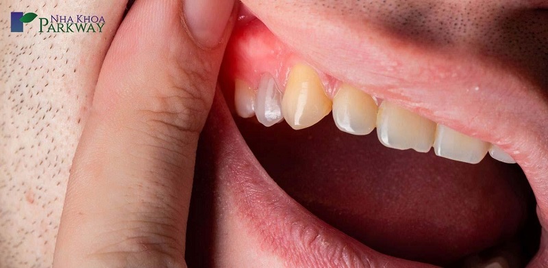 Viêm chân răng có mủ gây ra nhiều tác hại nặng nề cho người bệnh