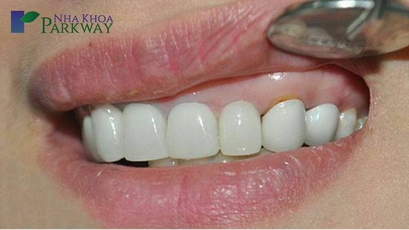 Dấu hiệu cho thấy răng sứ bị hở chân răng