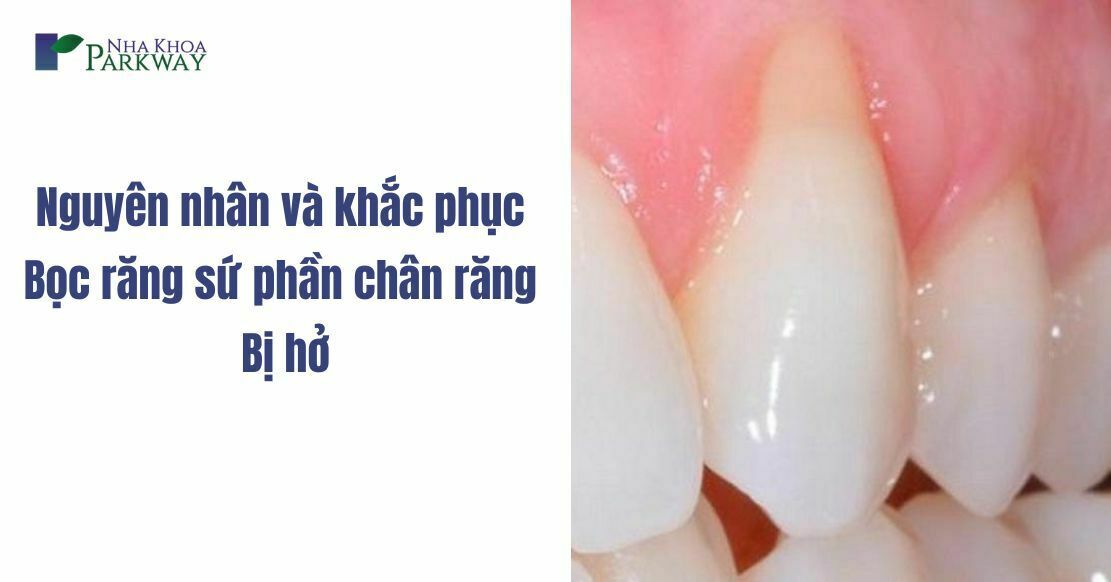 Nguyên nhân và khắc phục bọc răng sứ phần chân răng bị hở