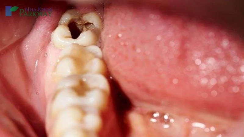 Sâu răng vào tủy phải làm sao? Biểu hiện và cách khắc phục