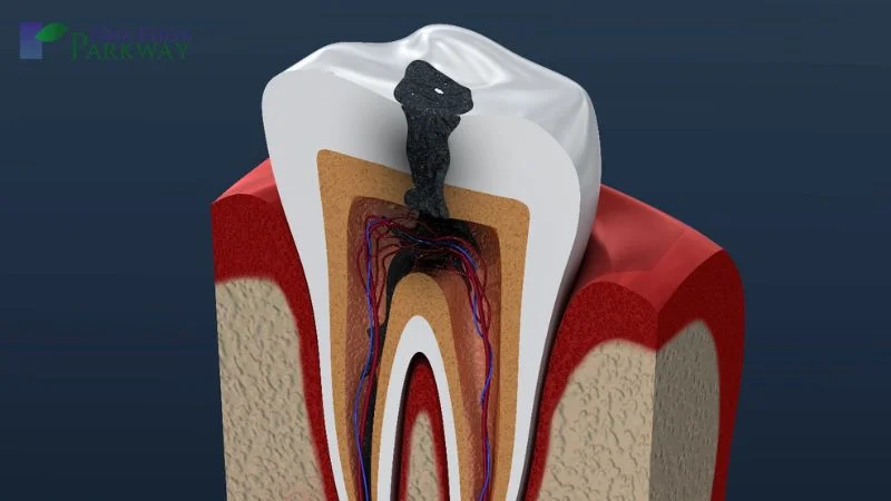 Thế nào là sâu răng vào tủy?