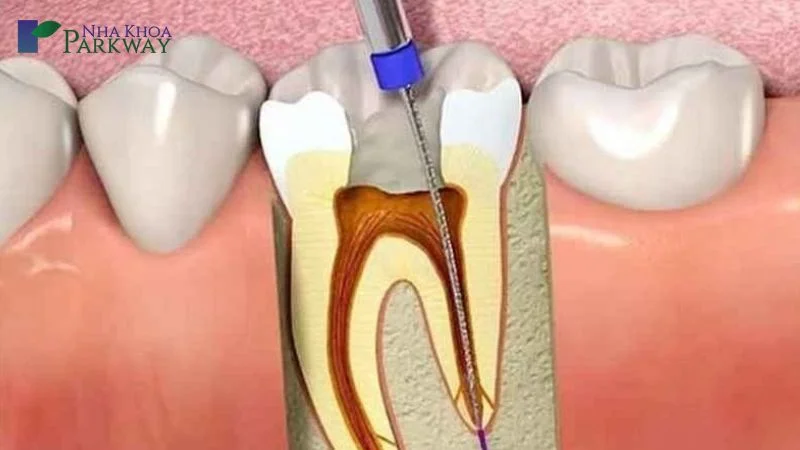 Cách điều trị sâu răng ăn vào tủy
