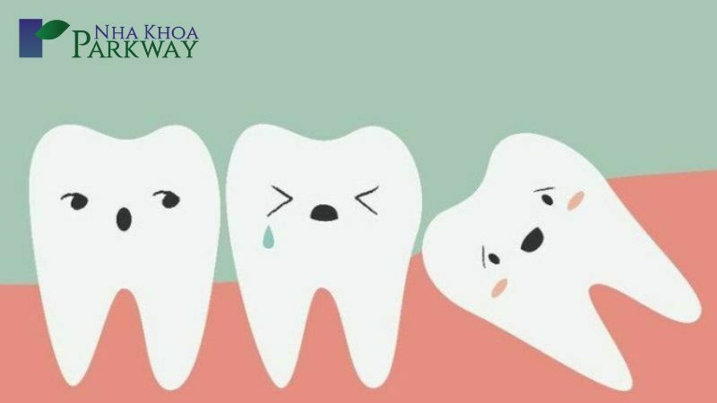 Những tác hại của việc răng số 8 mọc ngầm, mọc lệch gây ra