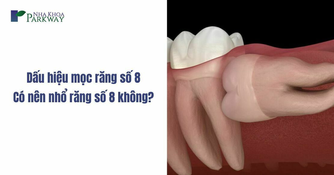 Dấu hiệu mọc răng số 8 - Có nên nhổ răng số 8 không?