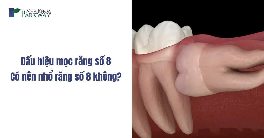 Dấu hiệu mọc răng số 8 - Có nên nhổ răng số 8 không?