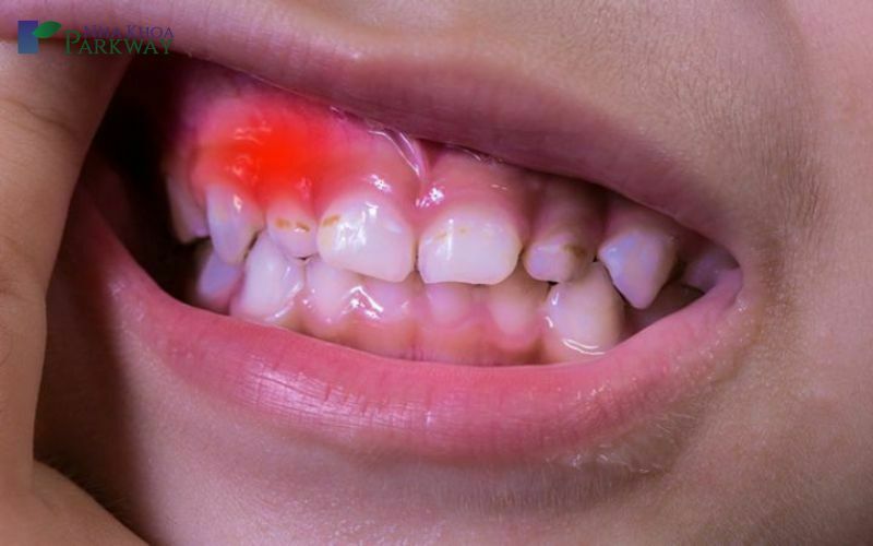Viêm chân răng gây sưng mặt ở trẻ là như thế nào? 