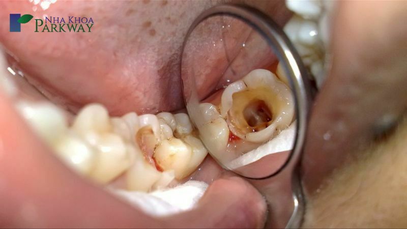 Triệu chứng của bệnh viêm tủy răng qua các giai đoạn