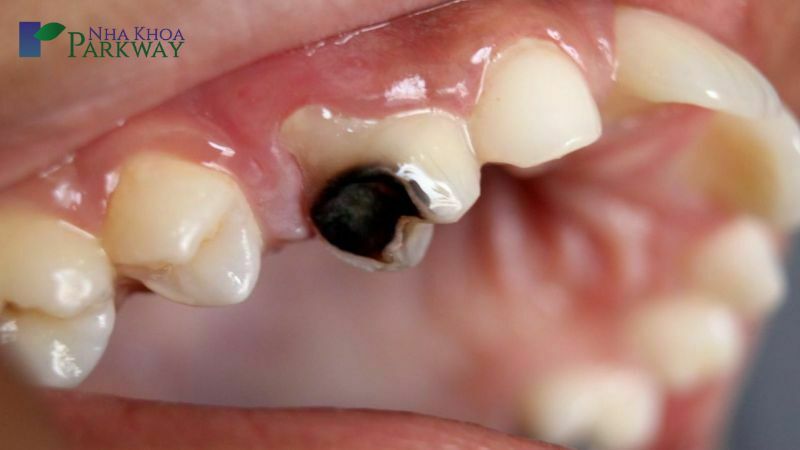 Nguyên nhân viêm tủy răng