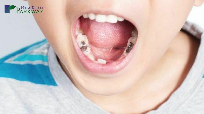 Nguyên nhân gây viêm tủy răng ở trẻ em