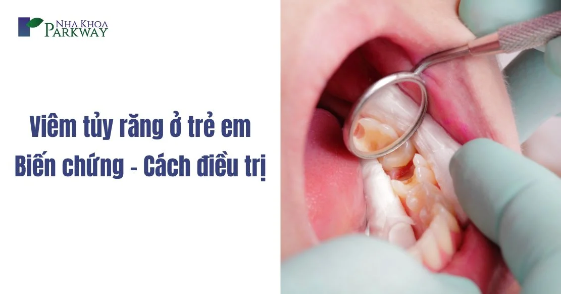 Biến chứng viêm tủy răng ở trẻ em - 2 Cách điều trị tốt nhất