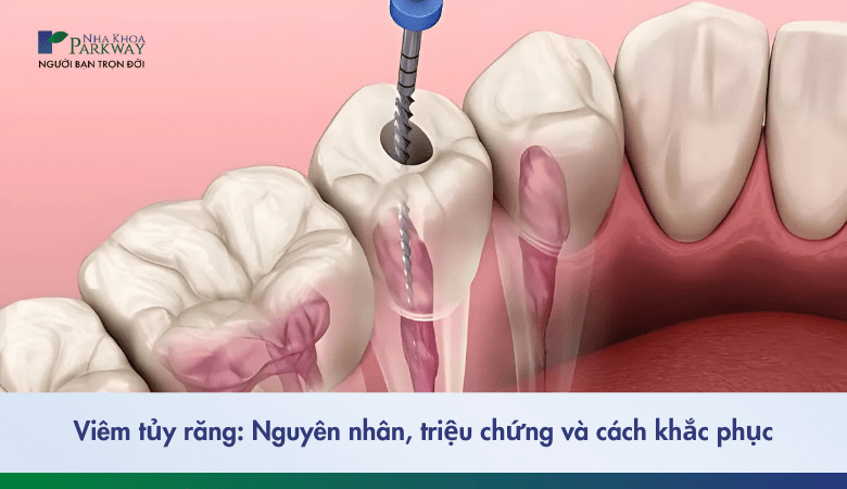 viêm tủy răng là gì