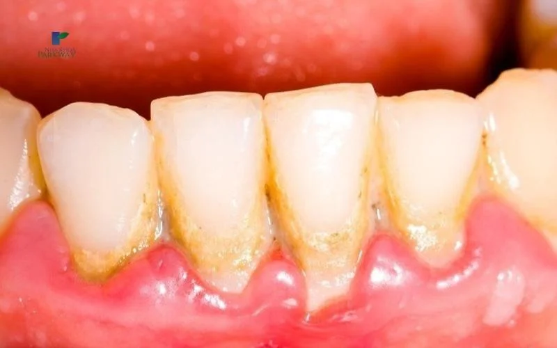 Cao răng là gì? Lý do phải lấy cao răng?