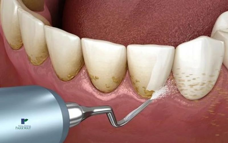 Tại sao lại có sự chênh lệch chi phí lấy cao răng tại các nha khoa