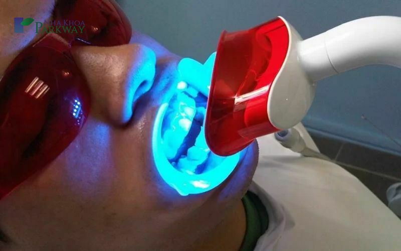 Tẩy trắng răng để điều trị chân răng bị vàng