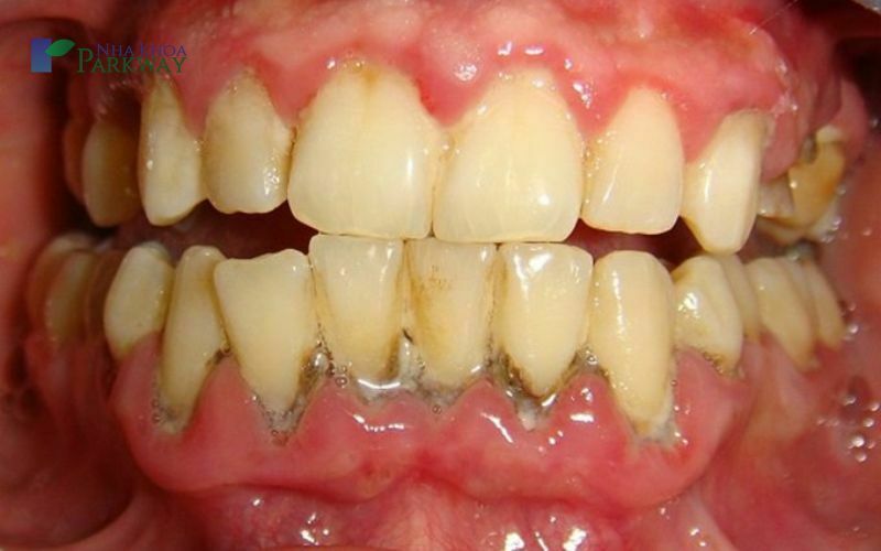 Chân răng bị vàng là gì? Những nguyên nhân làm chân răng bị vàng