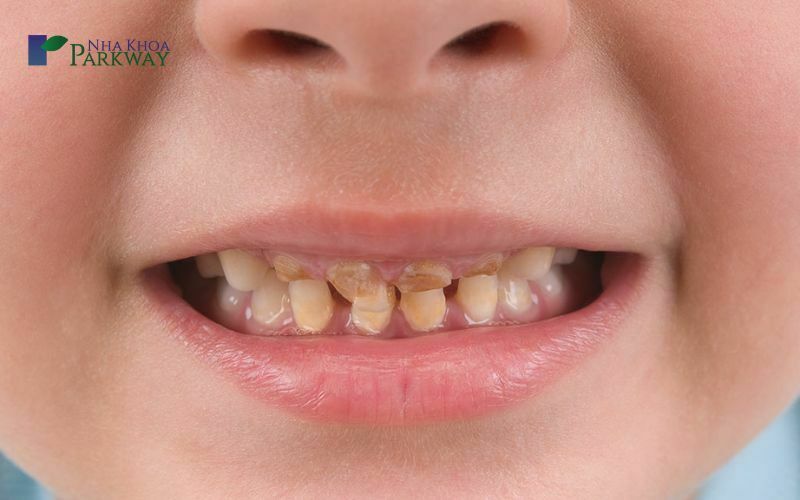 Tại sao răng bé bị vàng: Cách khắc phục khi răng bé bị vàng