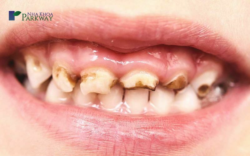 Tại sao răng bé bị vàng?