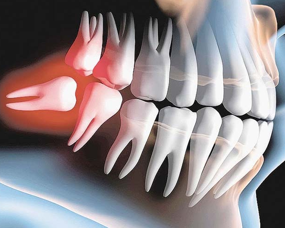 Răng số 8 mọc lệch nghiêng vào gây ảnh hưởng hư hại đến những răng xung quanh
