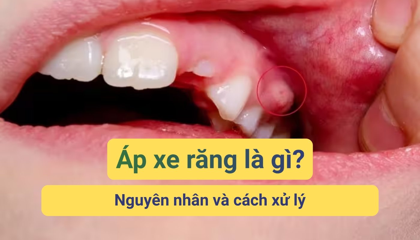 Áp xe răng là gì