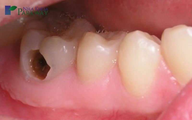 Nguyên nhân nào gây ra áp xe răng khôn?
