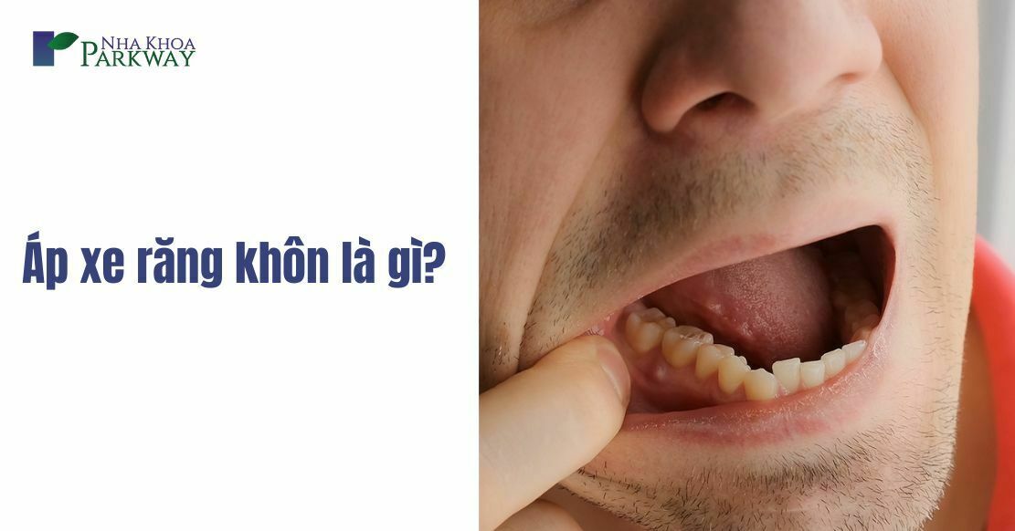 Áp xe răng khôn là gì? Có nên nhổ hay không?