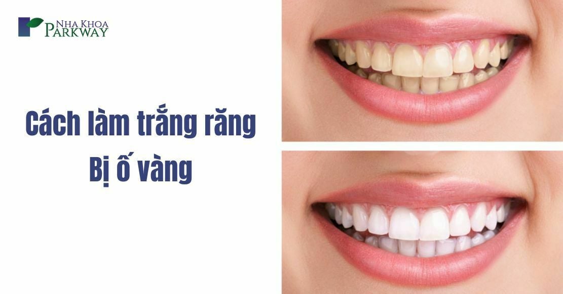 Top 17 cách làm trắng răng bị ố vàng tại nhà hiệu quả nhất