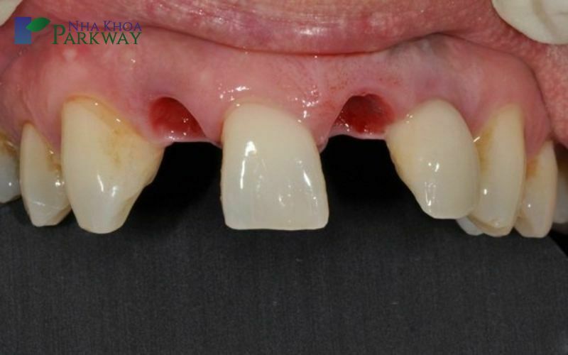 Điều trị sâu răng không triệt để dẫn đến tính trạng gì?