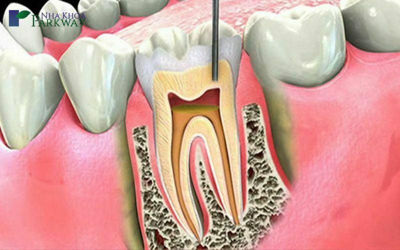 Quy trình chữa tủy răng cửa mới nhất hiện nay