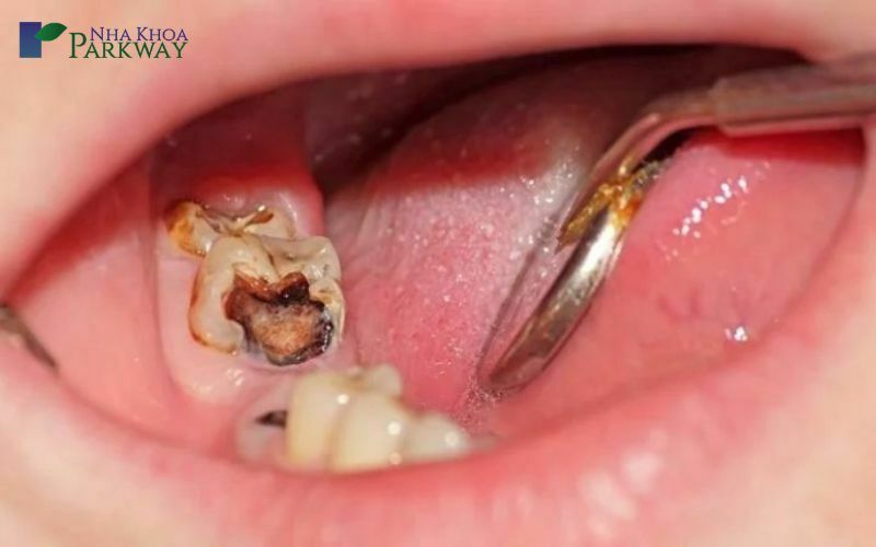 Viêm tủy răng số 6 là gì?