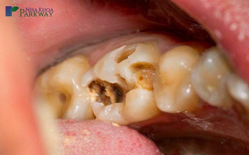 Triệu chứng của viêm tủy răng số 6