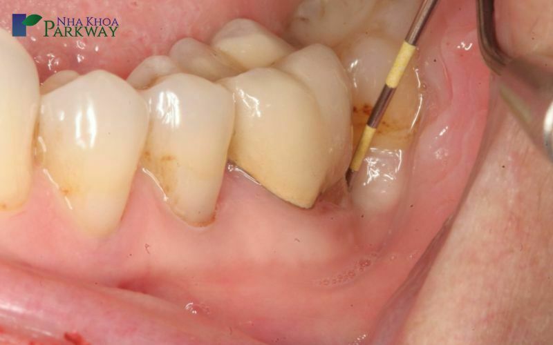 Biến chứng của viêm tủy răng số 7