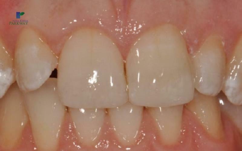 Có nên tự lấy cao răng tại nhà?