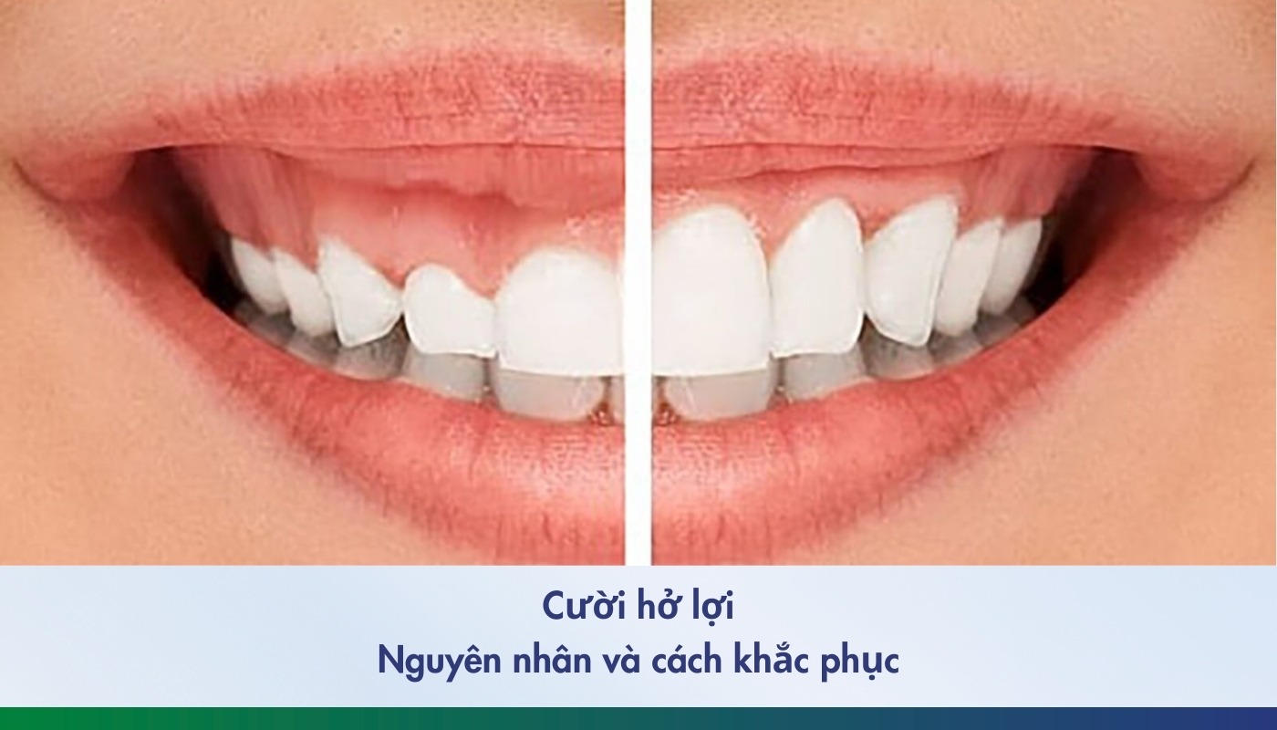 Nguyên nhân và cách điều trị cười hở lợi