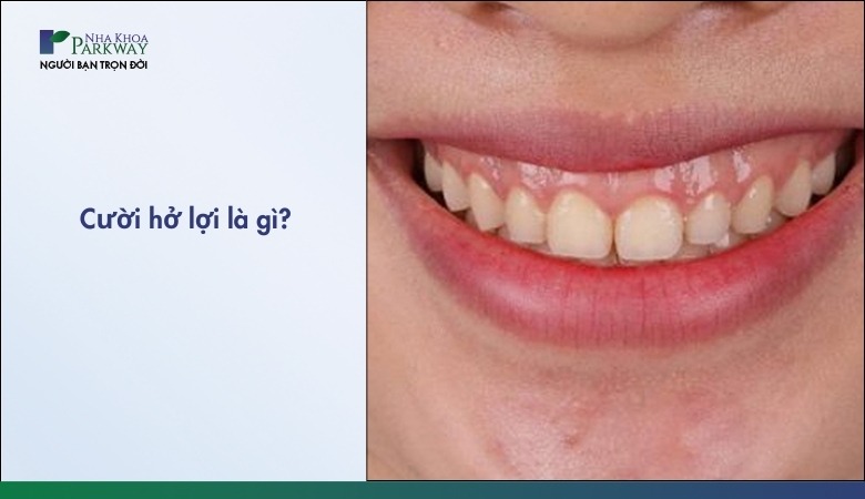 Cười hở lợi là gì