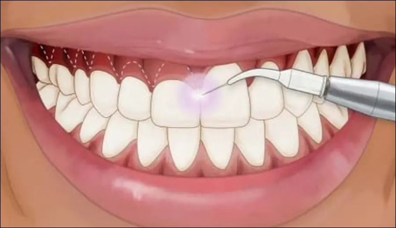 Cắt lợi làm dài thân răng