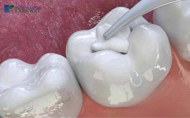 Quy trình điều trị tủy răng không đau và an toàn tại Parkway