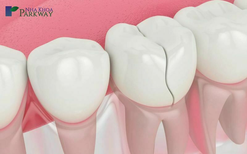 Dấu hiệu và trường hợp cần điều trị tủy răng