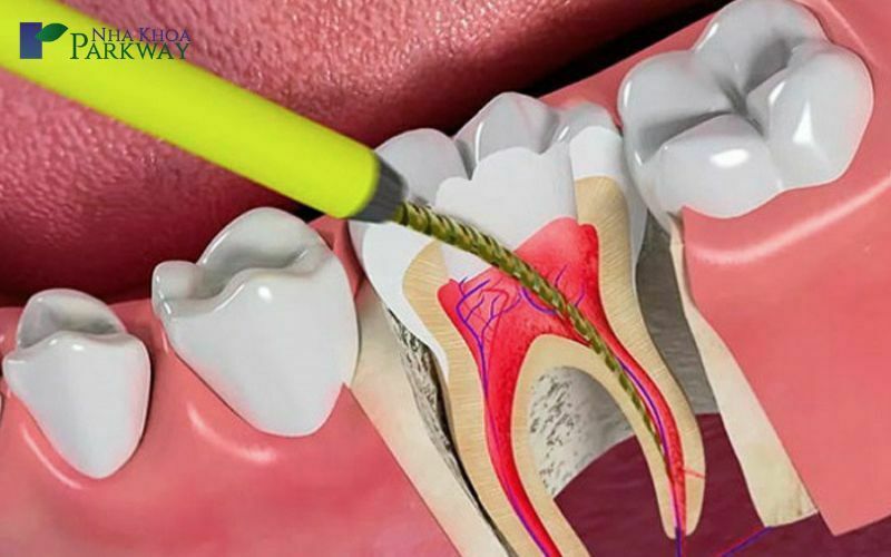 Lấy tủy răng hết bao nhiêu tiền với răng hàm (răng nhiều chân)