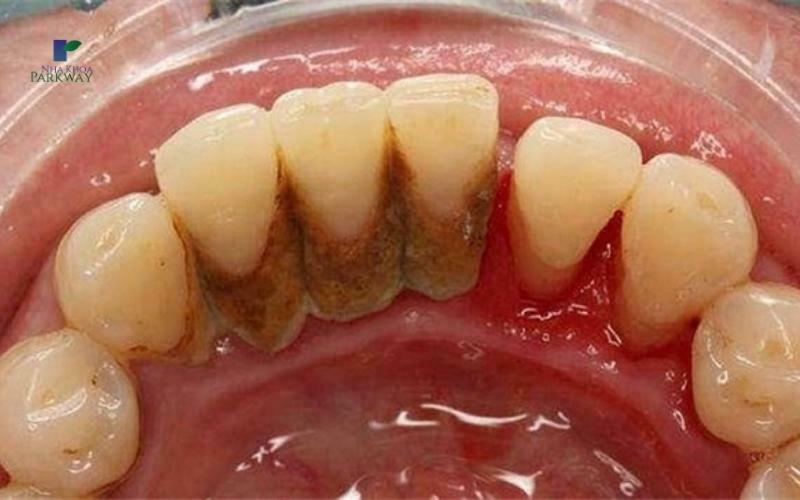 Cao răng là gì?