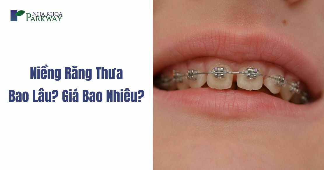 Niềng Răng Thưa Có Lâu Không? Giá Bao Nhiêu Tiền?