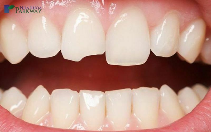 Nguyên nhân khiến răng bị ố vàng - Do bị chấn thương