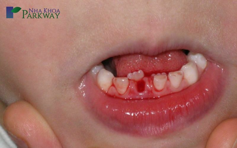 Nguyên nhân răng thưa là gì?