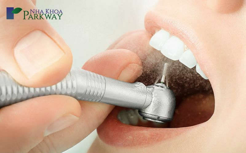 Cách điều trị răng thưa bằng phương pháp bọc răng sứ
