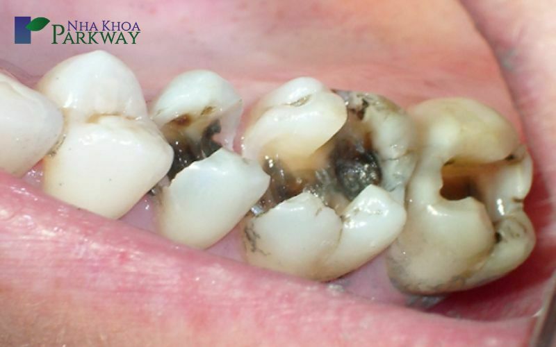 Sâu răng nặng là gì?