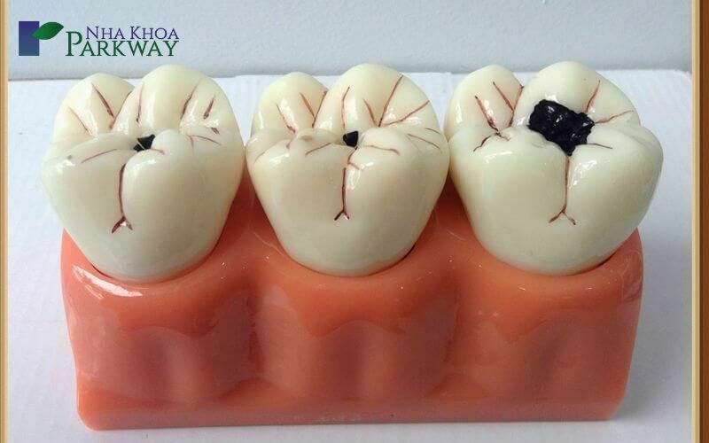 Sâu răng nặng có dấu hiệu nào để có thể nhận biết?