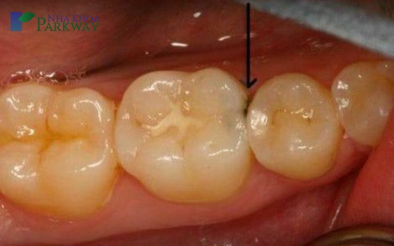 Nguyên nhân dẫn đến một hàm răng sâu