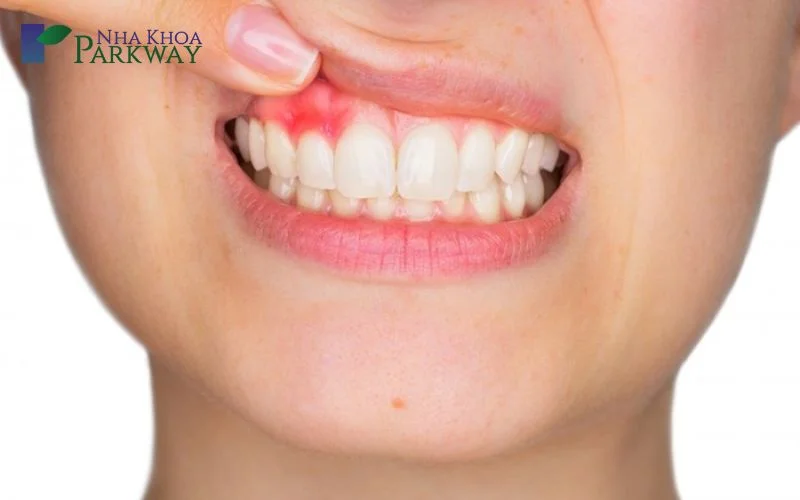 Sâu răng nặng gây ra những hậu quả như thế nào?