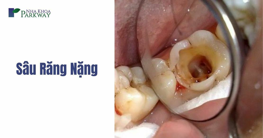 Dấu hiệu sâu răng nặng – Bị sâu răng nặng phải làm sao?